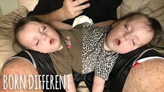 Conjoined Twins Are A Medical Miracle  BORN DIFFERENT [upl. by Swee]