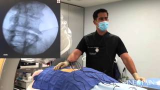 Radiofrequency Ablation Procedure [upl. by Erdnoid]