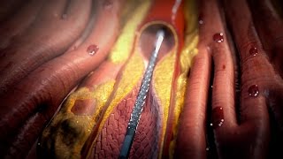 Stent Procedure [upl. by Ardeed183]